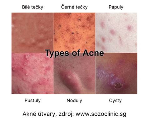 Infografika zobrazujúca rôzne typy akné a ich prejavy.