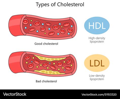 Detailná schéma rozdielu medzi LDL a HDL cholesterolom v krvnom obehu a ich vplyv na cievy
