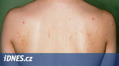 Fotografia typických kožných prejavov svrabu a lokalizácia na tele