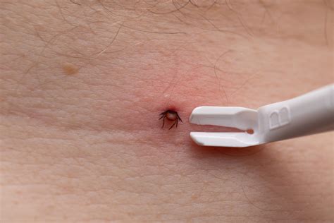 infografika s postupom správneho odstránenia kliešťa pomocou pinzety