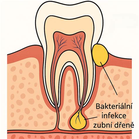 Schéma znázorňujúca prierez zuba a vznik abscesu pri koreni (periapikálny absces) vs. v ďasne (parodontálny absces)