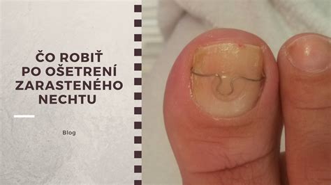Schéma správneho a nesprávneho strihania nechtov (rovno vs. do oblúka), zobrazenie zarasteného nechtu