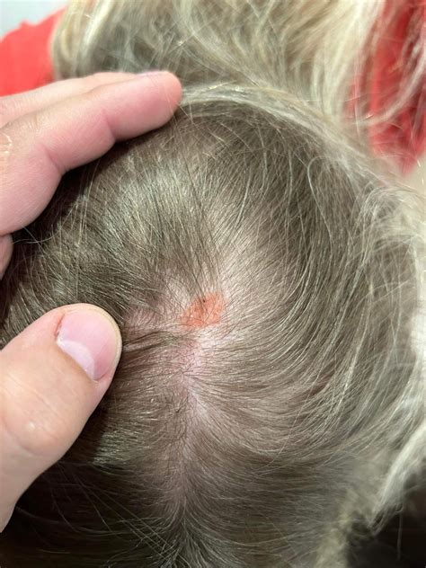 Ilustrácia novorodenca s typickou mliečnou chrastou na hlave