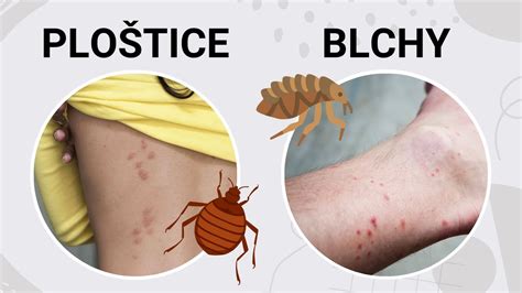 Infografika porovnávajúca štípance od ploštíc, komárov a bĺch
