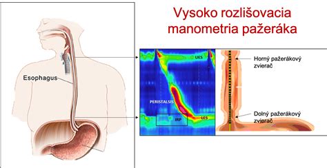 schéma tráviaceho traktu s označením pažeráka, žalúdka a dolného pažerákového zvierača