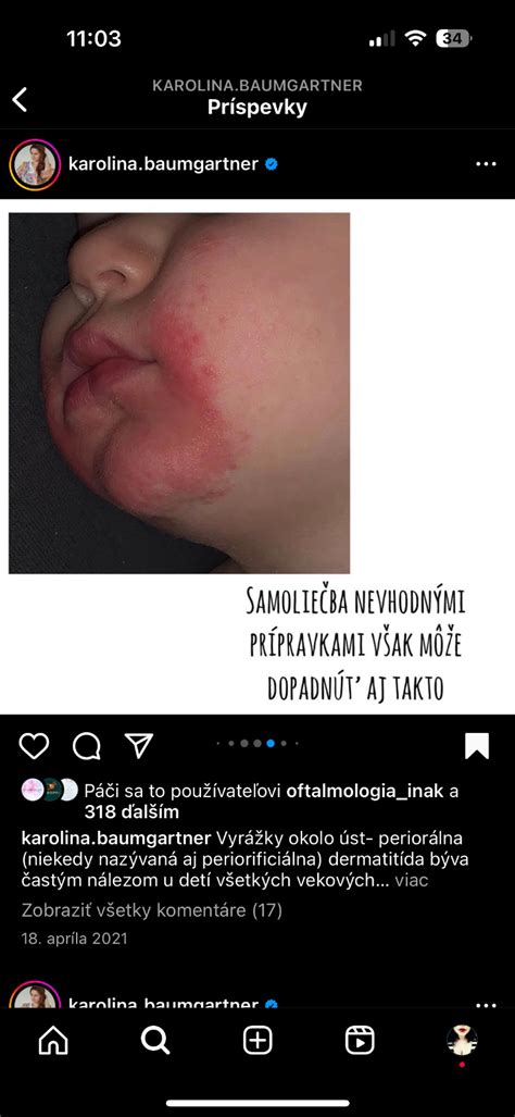 Fotografia dieťaťa s miernou kožnou reakciou okolo úst