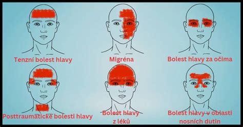 Schéma rozdelenia hlavy pri strihaní strojčekom: zóna zátylku, bočné partie a temeno