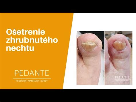 Detailné foto zhrubnutého nechtu postihnutého plesňou