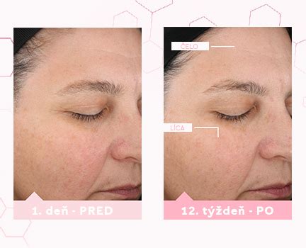 Porovnanie pleti pred a po vysadení antikoncepcie