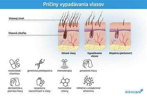 Schéma znázorňujúca rôzne príčiny vypadávania vlasov
