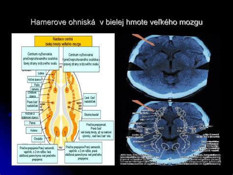 Schematické znázornenie nervových vlákien v bielej hmote mozgu
