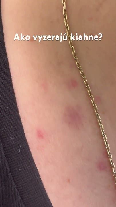 Detailné zobrazenie štádií vyrážok pri ovčích kiahňach