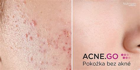 ukážka nanovlákenných masiek proti akné