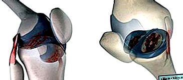 Schéma štruktúry kolenného kĺbu s poškodenou chrupavkou a znázornenie jej funkcie ako nárazníka