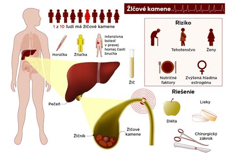 Infografika zobrazujúca príčiny a príznaky žlčníkového záchvatu