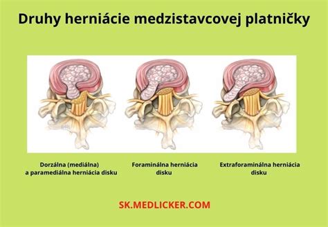 Schematické znázornenie stavby stavca a medzistavcovej platničky