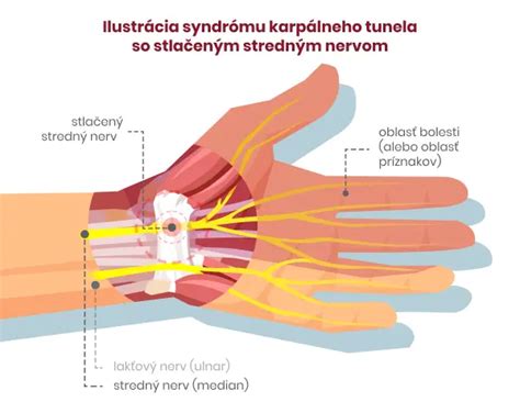 Schéma anatómie karpálneho tunela s vyznačeným stredovým nervom a šľachami