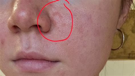 Schéma znázorňujúca lokalizáciu periorálnej dermatitídy v okolí úst, nosa a brady.