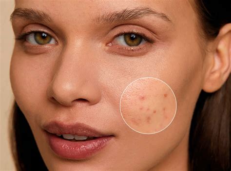 Koláž rôznych problémov s pokožkou (akné, suchá pleť) a prísady pomarančovej kôry