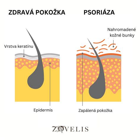Ilustrácia rôznych typov bradavíc na pokožke
