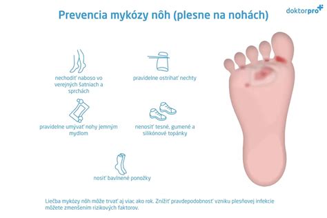 ilustrácia plesne na nohách a jej úľava po použití dubovej kôry