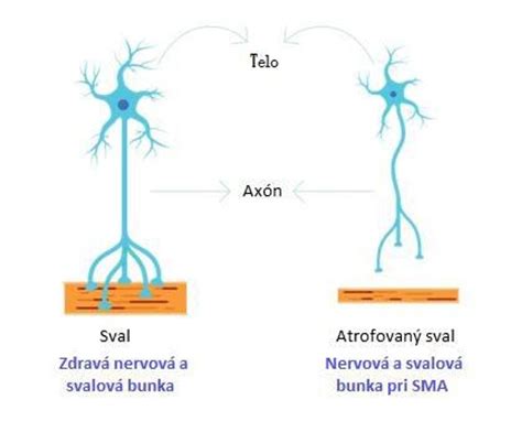 schéma znázorňujúca rozdiel medzi zdravým listom a listom s chlorózou (žltnutie medzi žilnatinou)