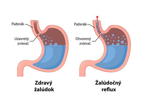 Schéma tráviaceho traktu so zvýraznením citlivých oblastí žalúdka a čriev pri reakcii na dráždivé látky