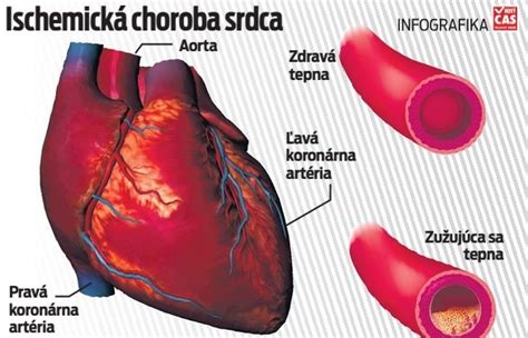 Schéma najčastejších príčin opadávania listov: prievan, suchý vzduch, nesprávna zálievka a nedostatok svetla.