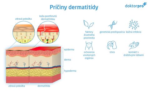 infografika s definíciou a príznakmi periorálnej dermatitídy